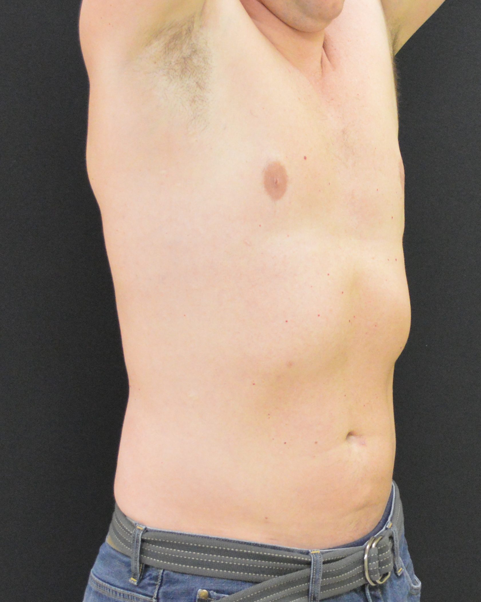 Liposuction Patient Photo - Case 12147 - after view-1