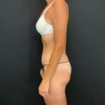C.L.A.S.S.™ Tummy Tuck - Case 12345 - After