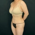 C.L.A.S.S.™ Tummy Tuck - Case 13037 - After