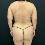 Liposuction - Case 13045 - Before