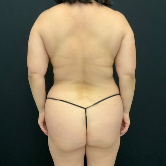 Liposuction Patient Photo - Case 13045 - before view-
