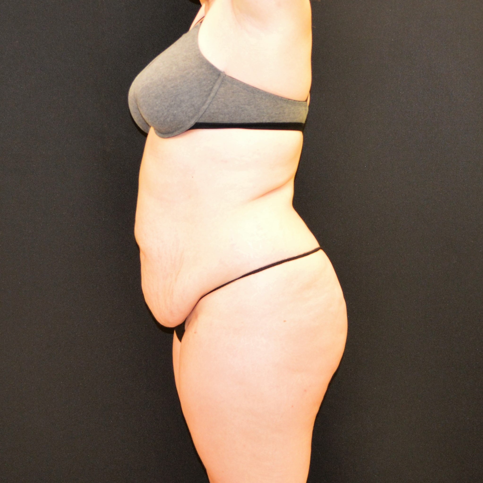 C.L.A.S.S. Tummy Tuck™ Patient Photo - Case 13143 - before view-1