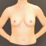 Breast Augmentation - Case 13171 - After