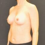 Breast Augmentation - Case 13175 - After