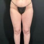 Liposuction - Case 13316 - After