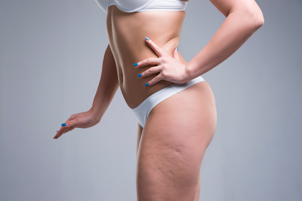 Is VelaShape Really Effective at Reducing Cellulite