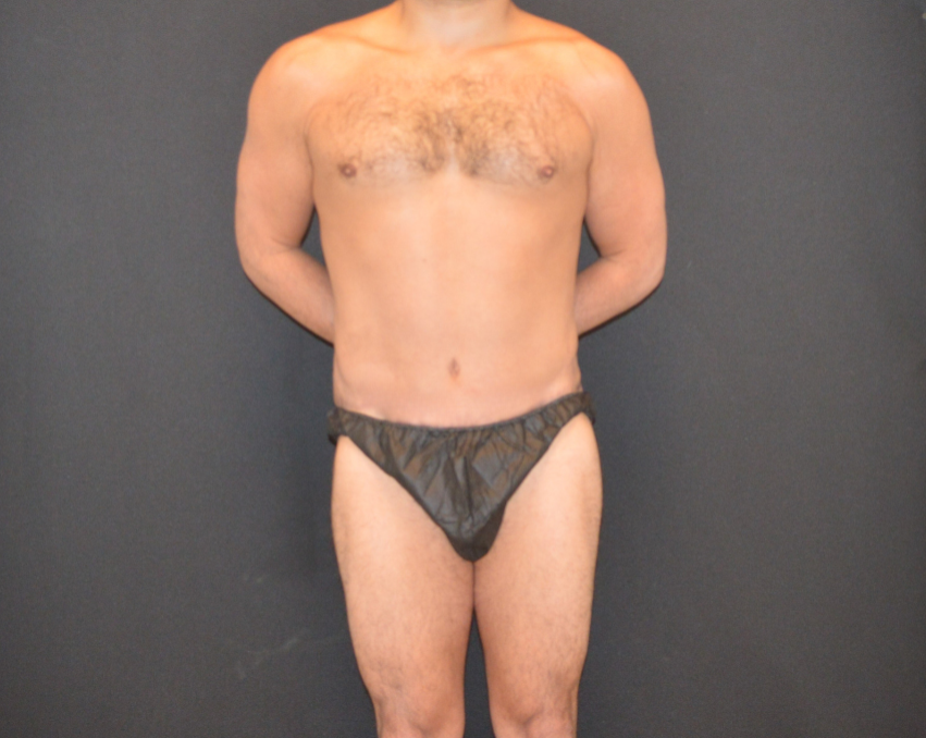 C.L.A.S.S. Tummy Tuck™ - Case 13757 - After