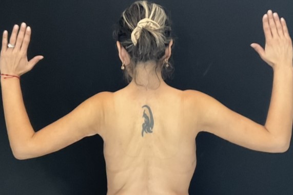 Arm Lift - Case 14285 - After