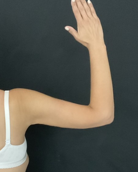 Arm Lift - Case 14436 - After