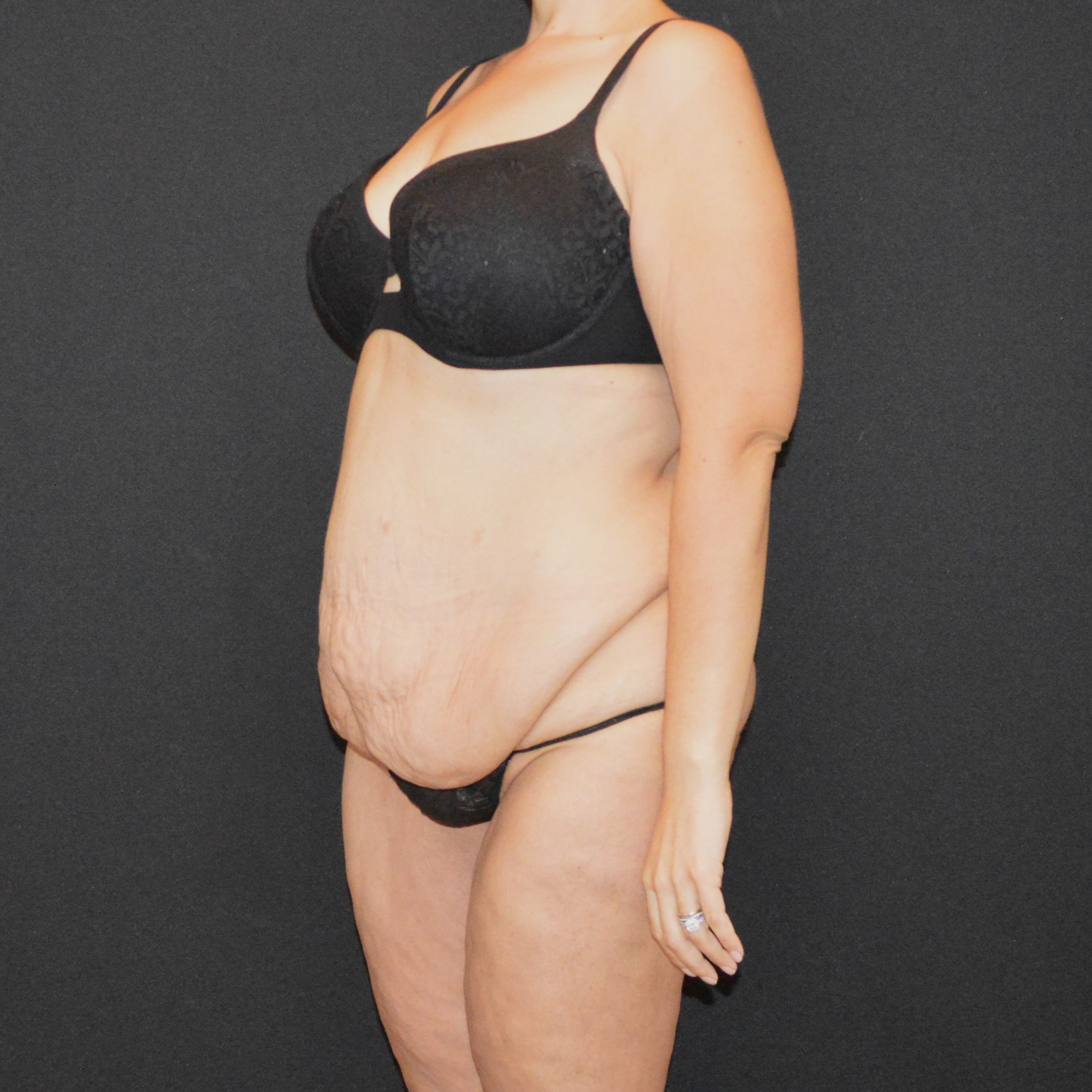 After Massive Weight Loss - Case 14445 - Before