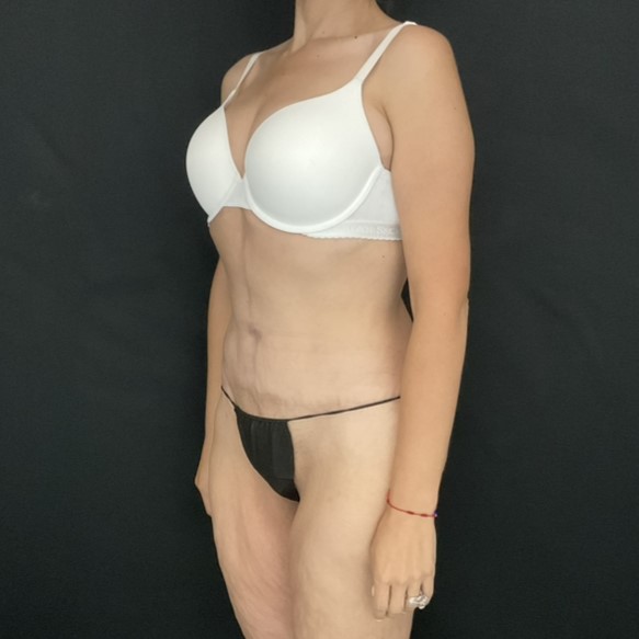 After Massive Weight Loss - Case 14445 - After