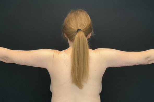 After Massive Weight Loss - Case 14608 - After