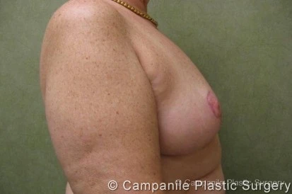 Breast Reduction - Case 167 - After