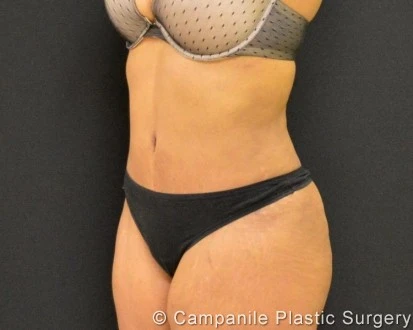 C.L.A.S.S. Tummy Tuck™ Patient Photo - Case 261 - after view-1