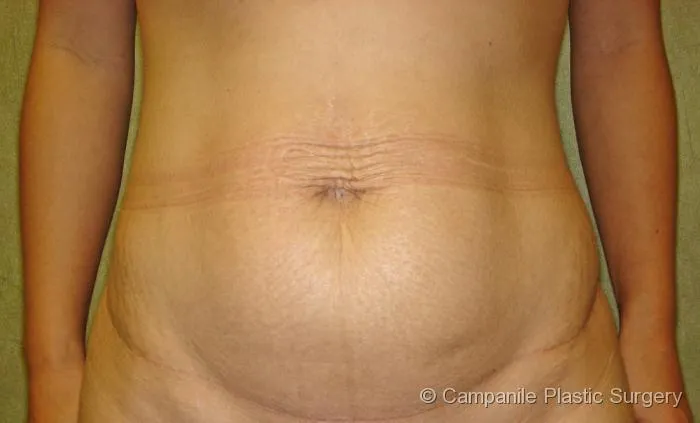 C.L.A.S.S. Tummy Tuck™ - Case 44 - Before
