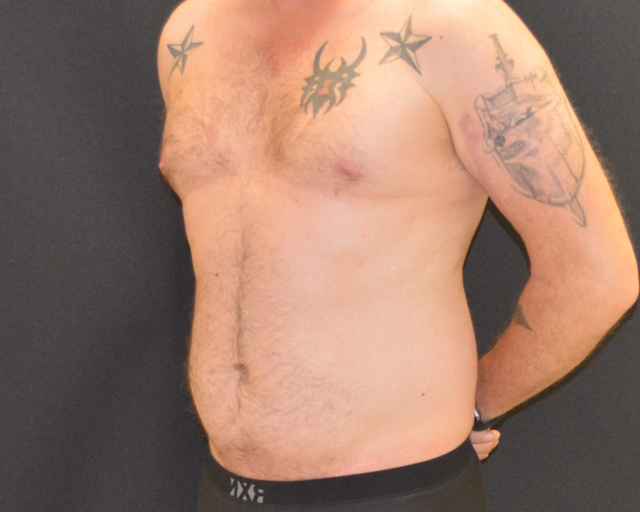 Liposuction Patient Photo - Case 316 - before view-1