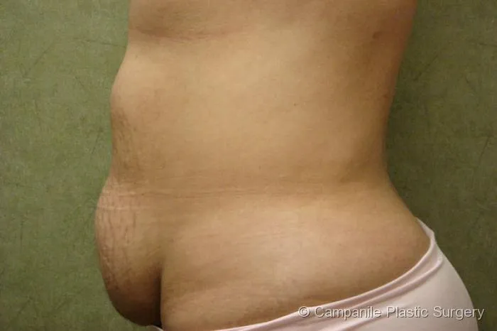 C.L.A.S.S. Tummy Tuck™ - Case 30 - Before