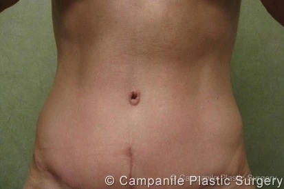 C.L.A.S.S. Tummy Tuck™ - Case 43 - After