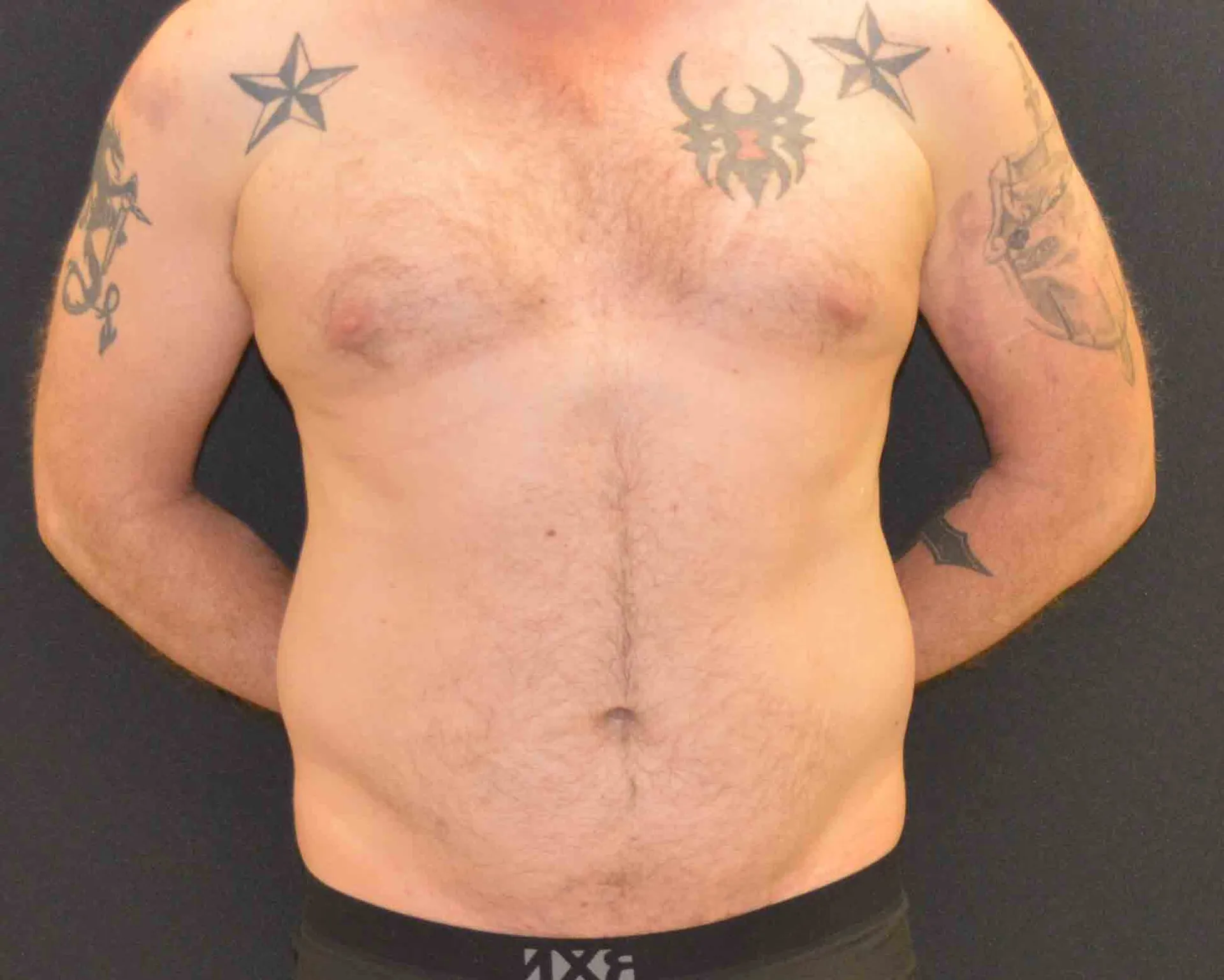 Liposuction - Case 316 - Before