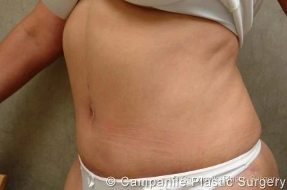 C.L.A.S.S. Tummy Tuck™ - Case 15 - After