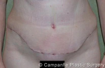 C.L.A.S.S. Tummy Tuck™ - Case 45 - After