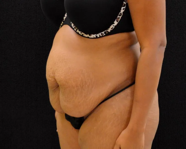 C.L.A.S.S. Tummy Tuck™ - Case 221 - Before