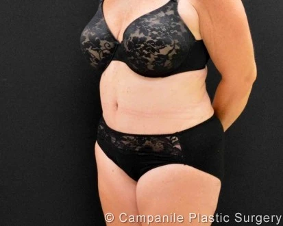 C.L.A.S.S. Tummy Tuck™ Patient Photo - Case 310 - after view-1