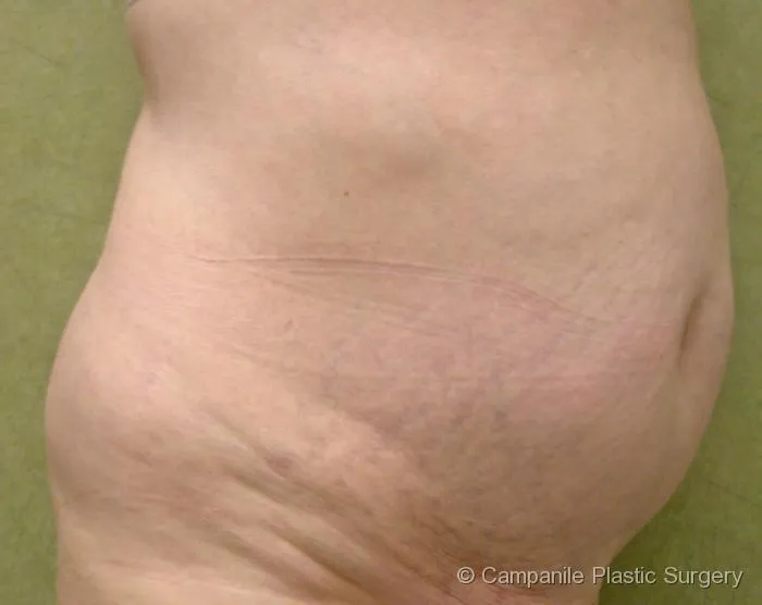 C.L.A.S.S. Tummy Tuck™ - Case 42 - Before