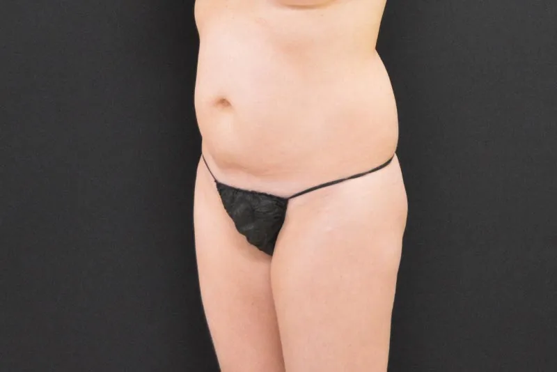 C.L.A.S.S. Tummy Tuck™ - Case 268 - Before