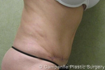 C.L.A.S.S. Tummy Tuck™ Patient Photo - Case 21 - after view