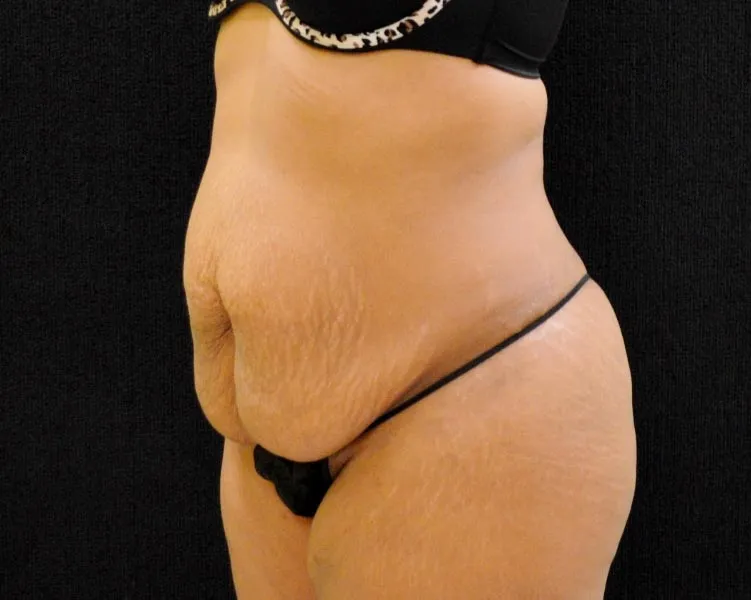 C.L.A.S.S. Tummy Tuck™ Patient Photo - Case 261 - before view-1