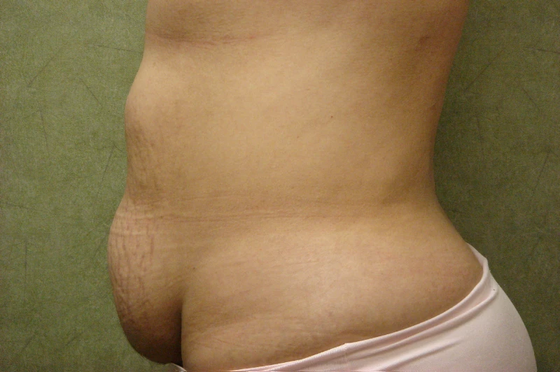 C.L.A.S.S. Tummy Tuck™ Patient Photo - Case 220 - before view-1