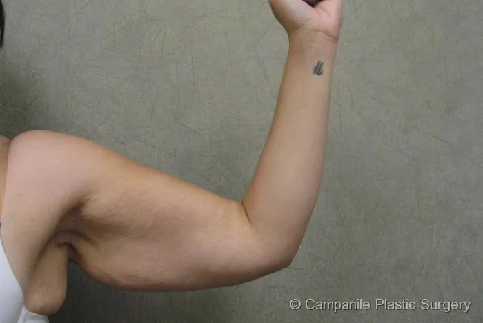 Arm Lift - Case 80 - Before