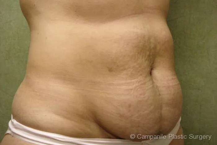 C.L.A.S.S. Tummy Tuck™ Patient Photo - Case 30 - before view-1