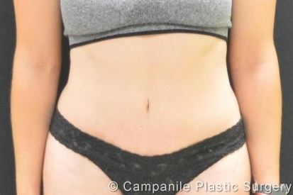 C.L.A.S.S. Tummy Tuck™ - Case 295 - After