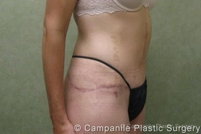After Massive Weight Loss - Case 90 - After