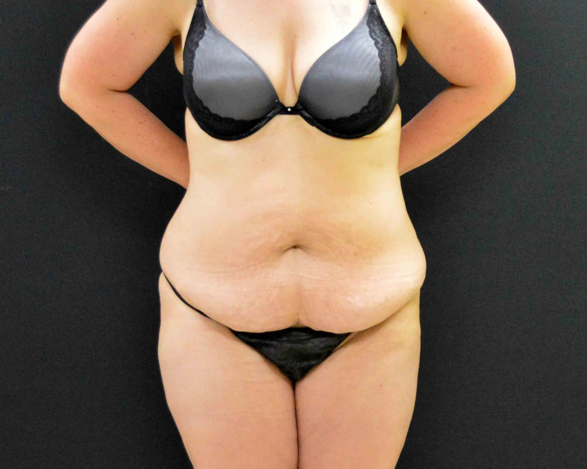 C.L.A.S.S. Tummy Tuck™ - Case 336 - Before