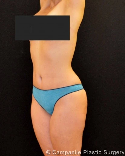 C.L.A.S.S. Tummy Tuck™ - Case 343 - After