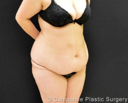 C.L.A.S.S. Tummy Tuck™ Patient Photo - Case 354 - before view-1