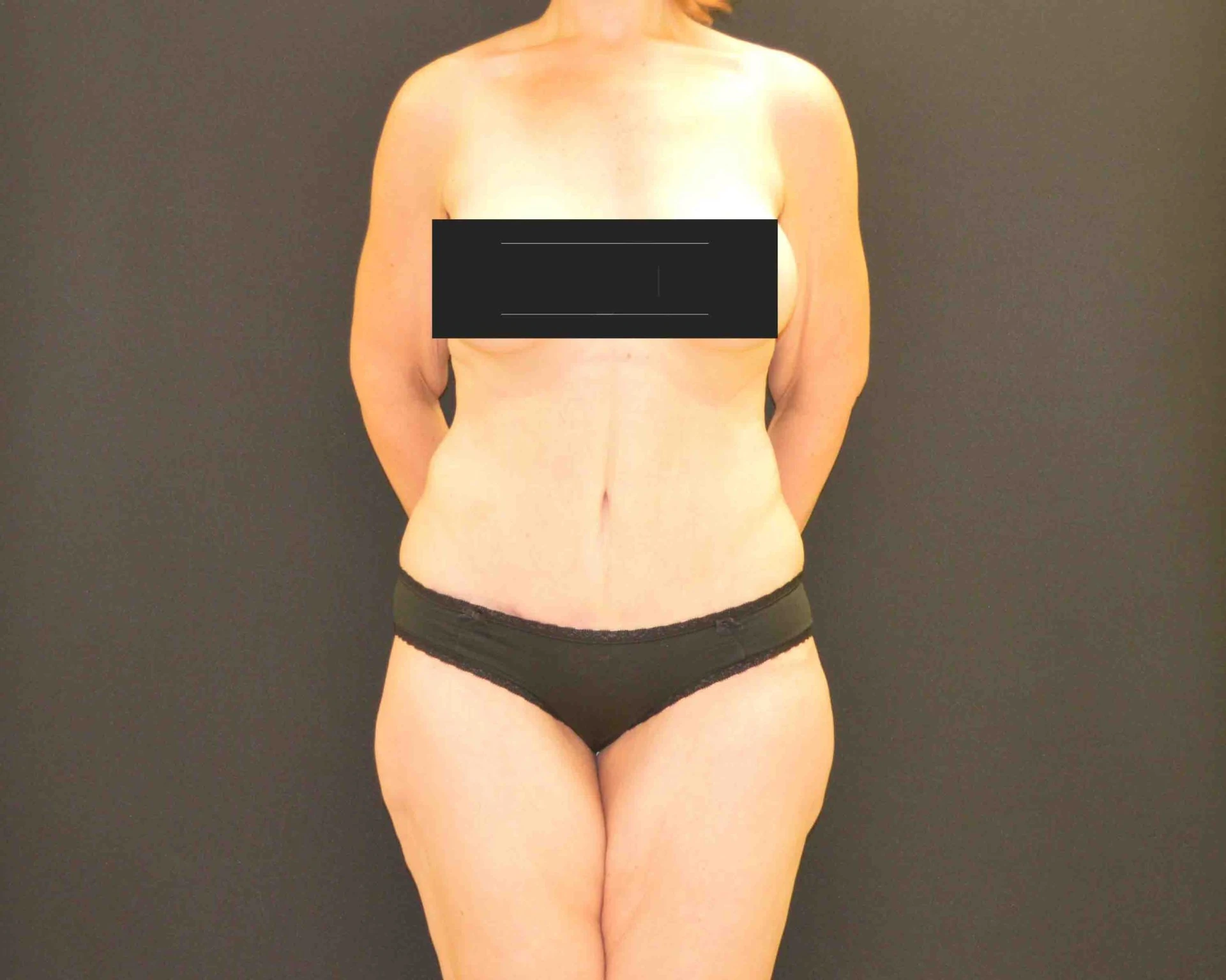 C.L.A.S.S. Tummy Tuck™ Patient Photo - Case 359 - after view