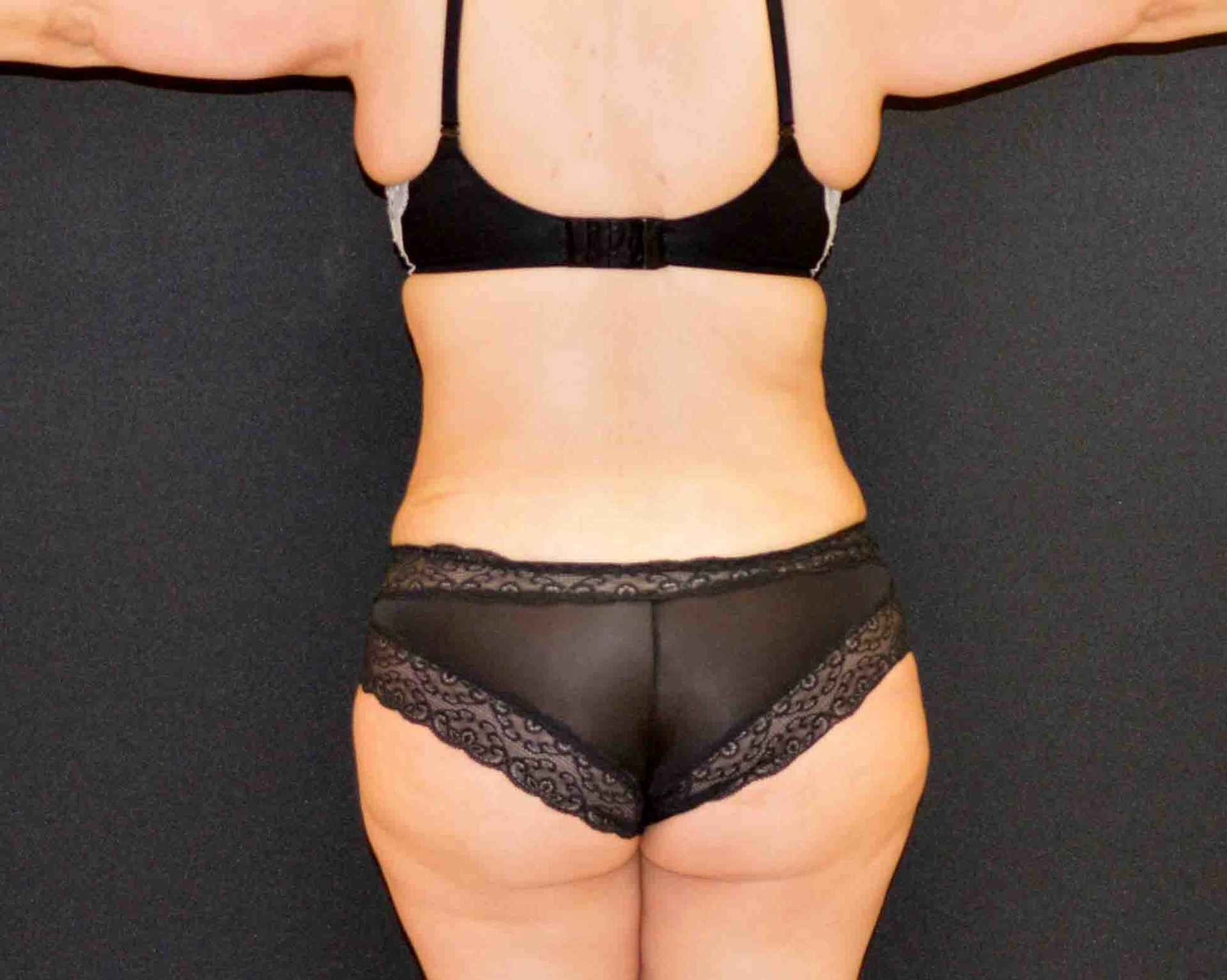 Liposuction Patient Photo - Case 370 - after view