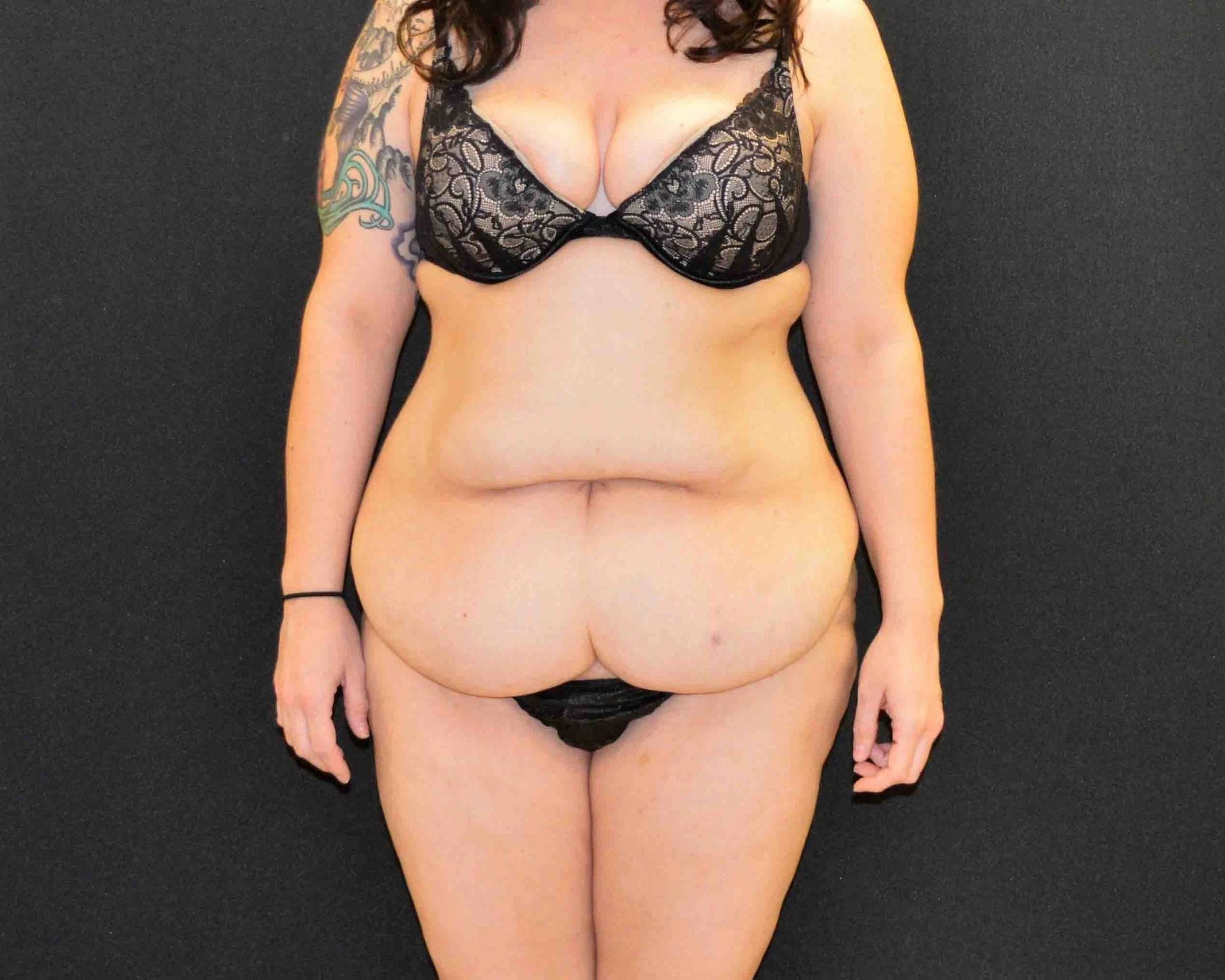 C.L.A.S.S. Tummy Tuck™ - Case 374 - Before