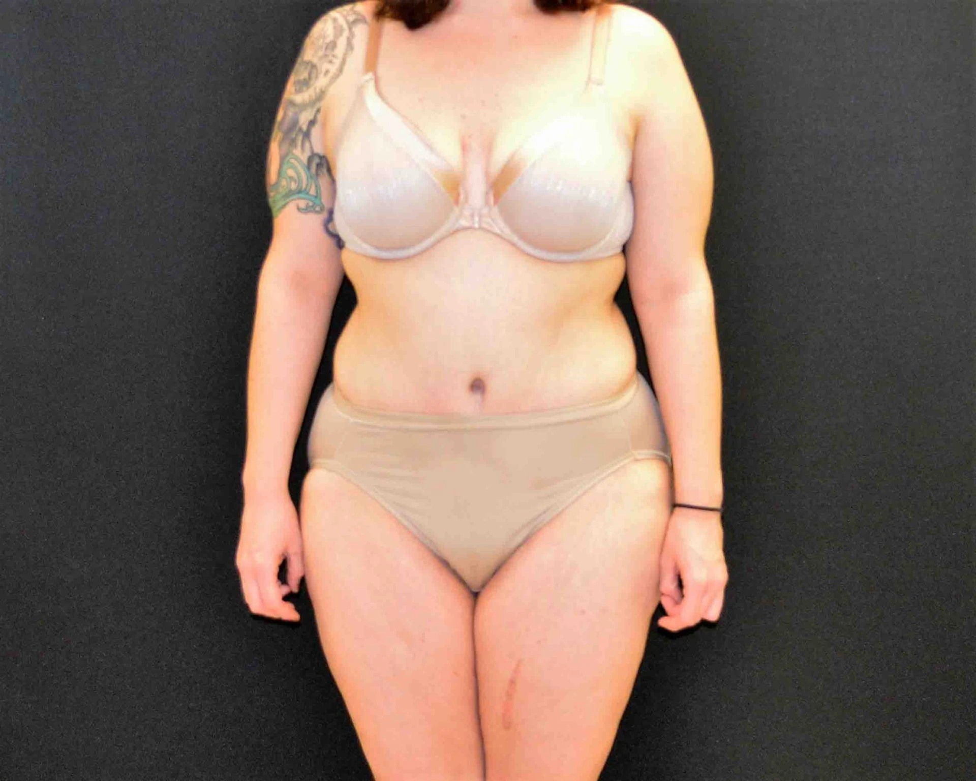 After Massive Weight Loss Patient Photo - Case 374 - after view