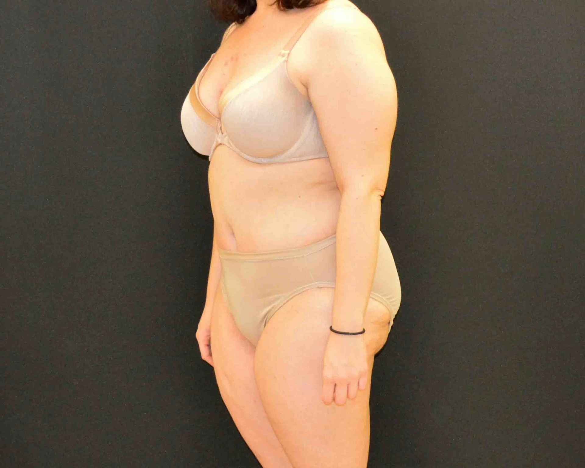 After Massive Weight Loss Patient Photo - Case 374 - after view-1