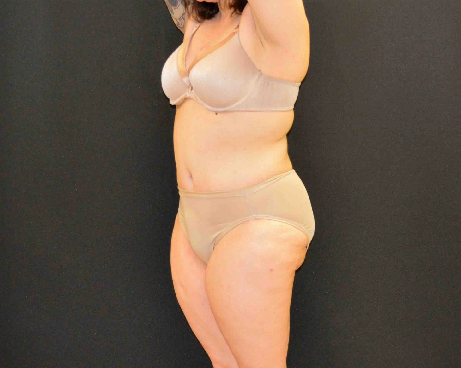 After Massive Weight Loss - Case 375 - After