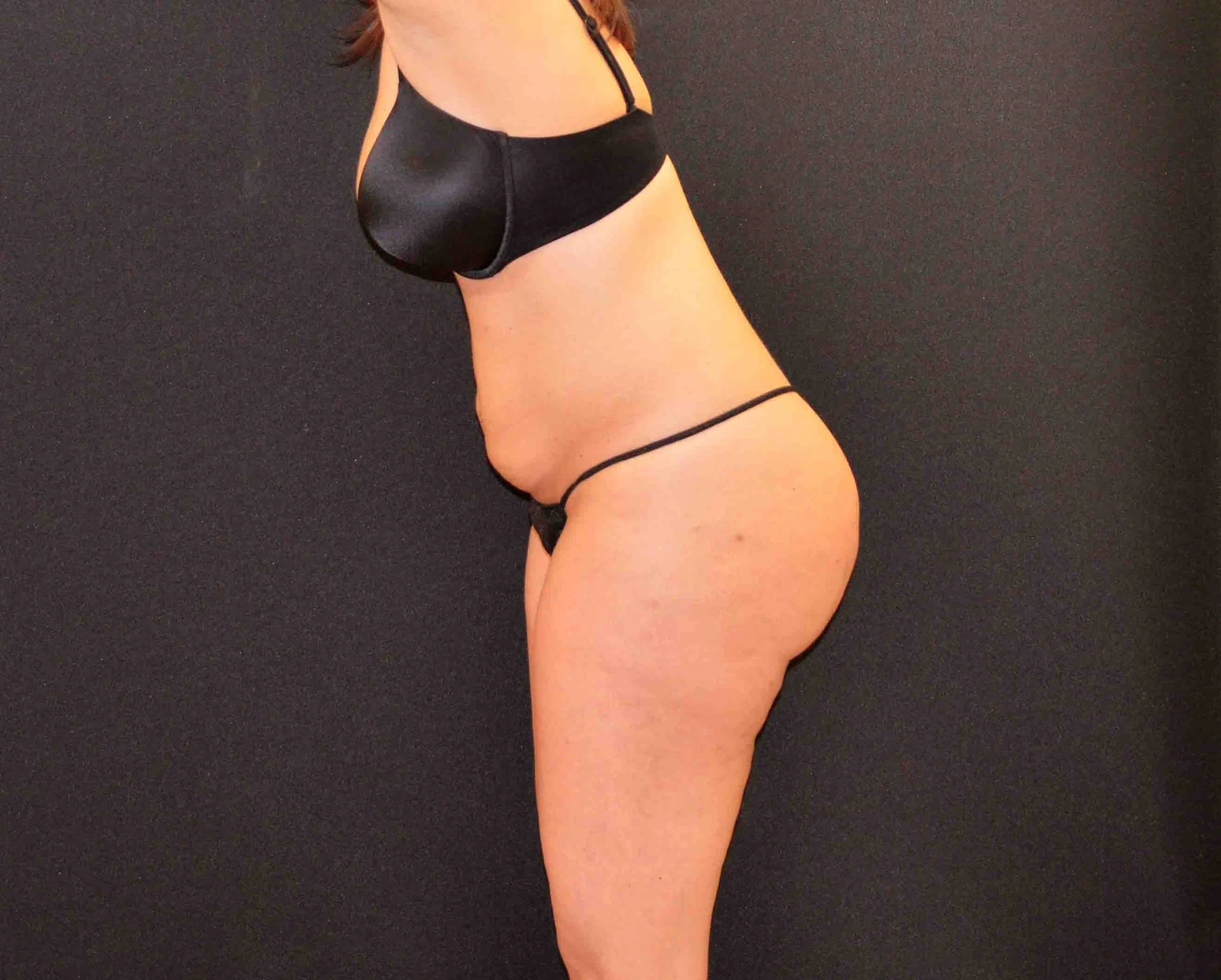 C.L.A.S.S. Tummy Tuck™ Patient Photo - Case 382 - before view-1