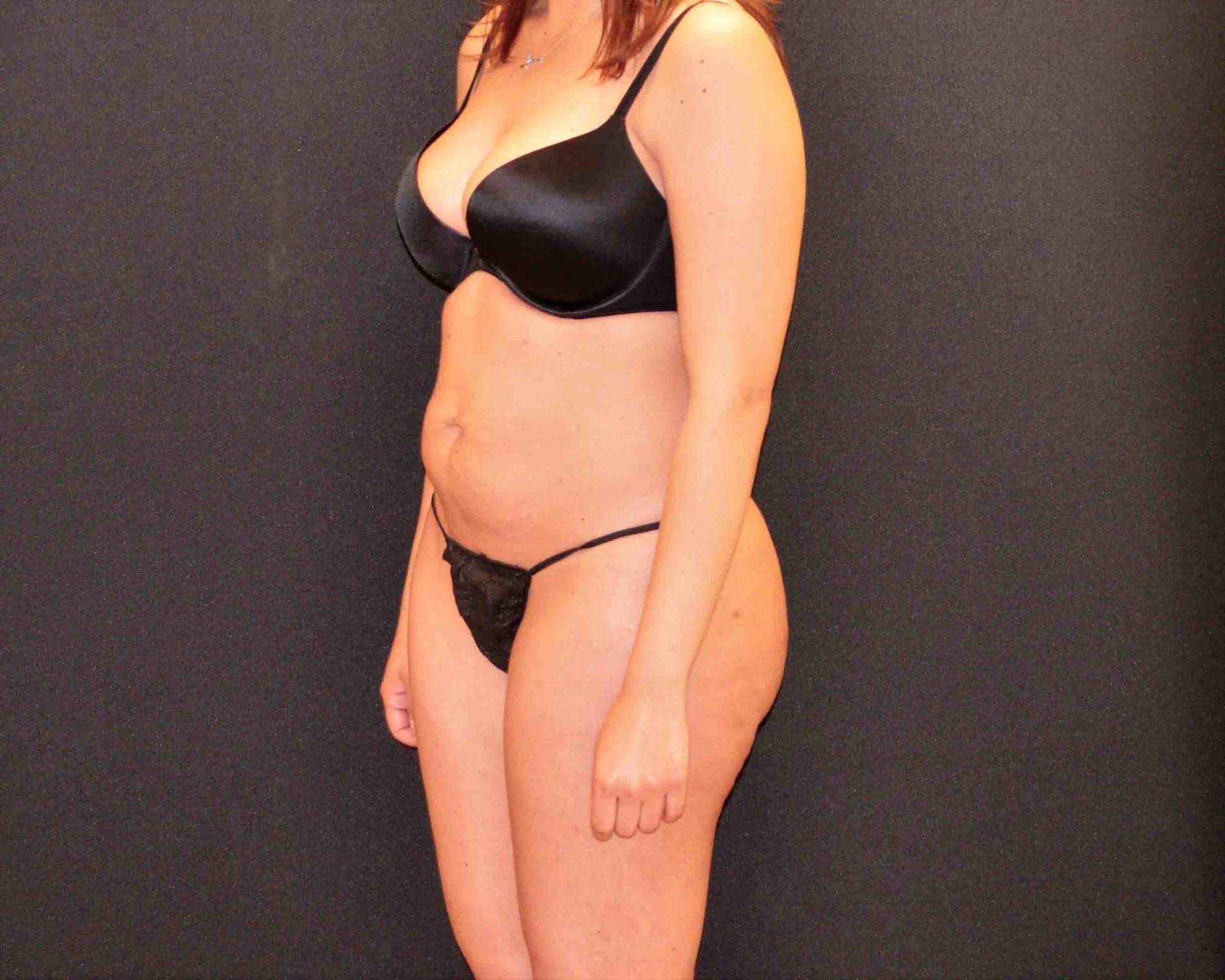 C.L.A.S.S. Tummy Tuck™ - Case 382 - Before