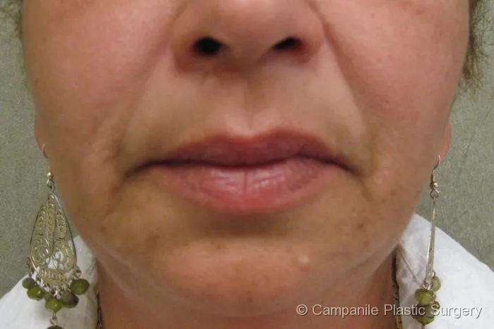 Medical Spa Procedures - Case 12 - Before