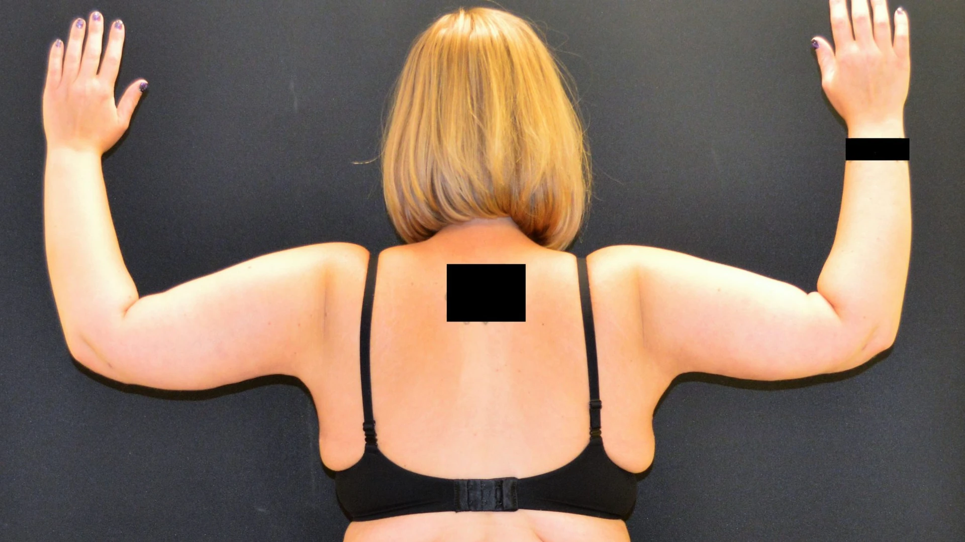 After Massive Weight Loss Patient Photo - Case 408 - after view