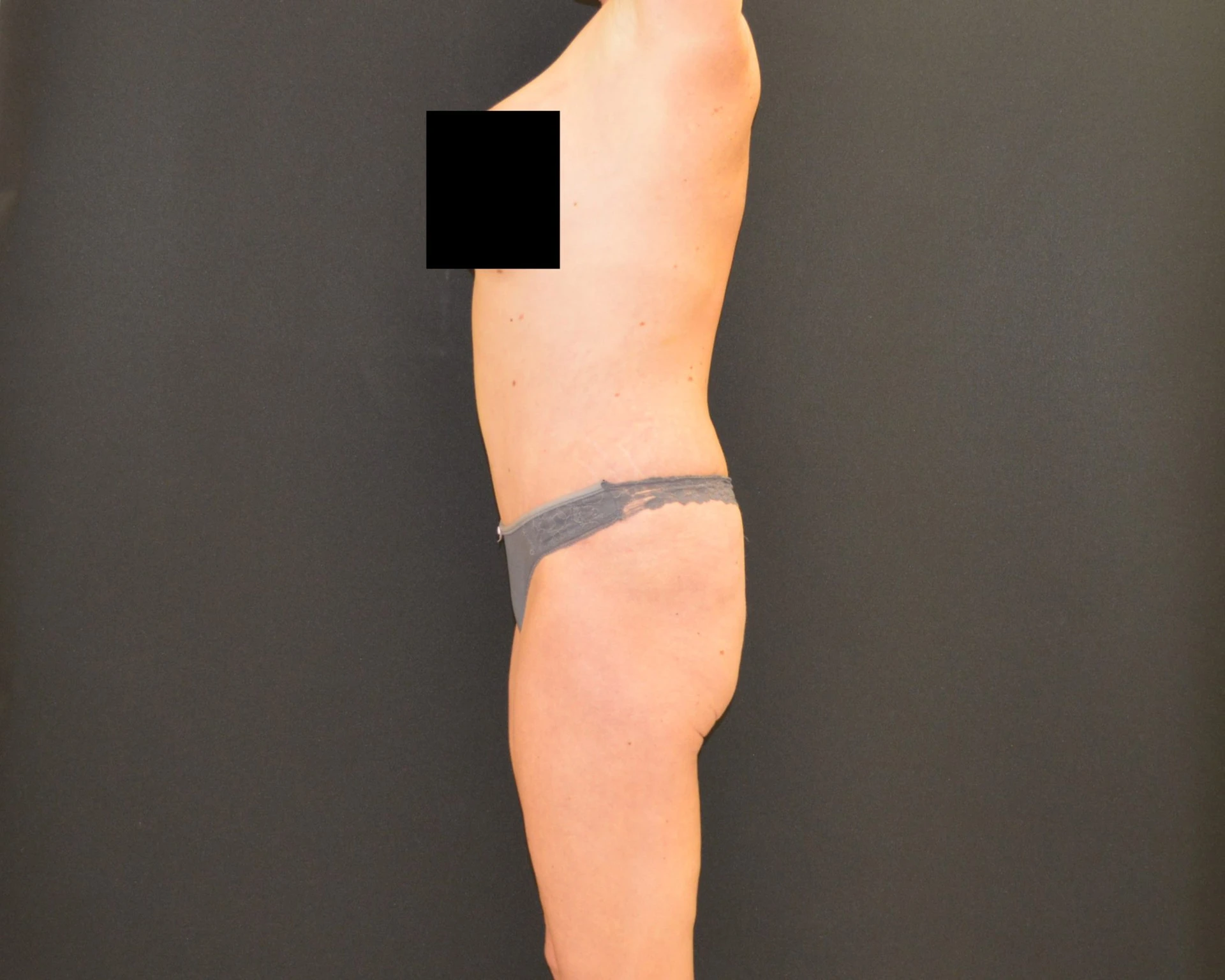 C.L.A.S.S. Tummy Tuck™ - Case 440 - After